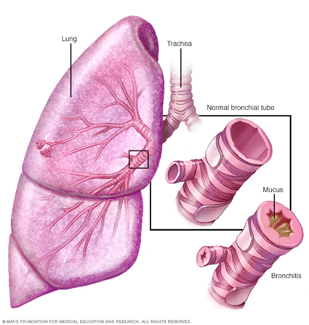 Illustration of chronic bronchitis showing narrowed bronchial tubes and mucus