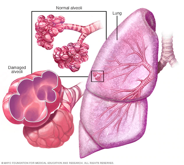 Illustration of emphysema showing normal and damaged alveoli
