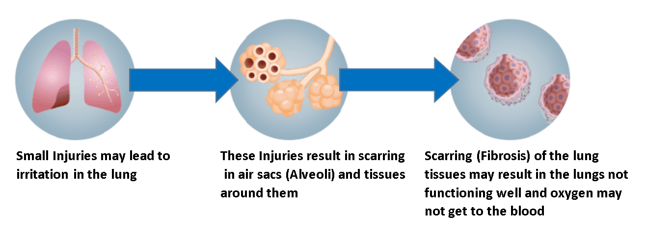 Illustration showing lung injury progressing to scarring and reduced oxygen transfer