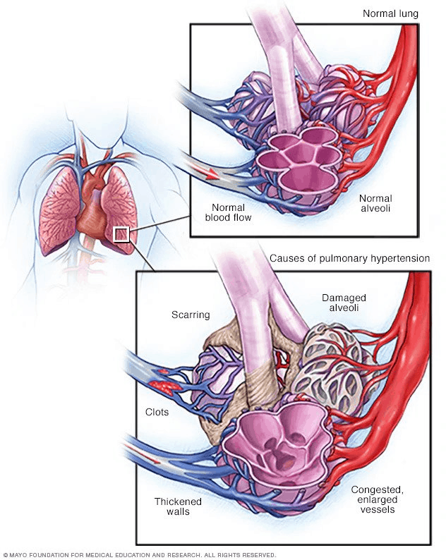Illustration comparing normal lung circulation with changes that can cause pulmonary hypertension