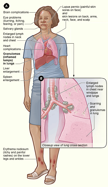 Illustration of signs and organ involvement in sarcoidosis