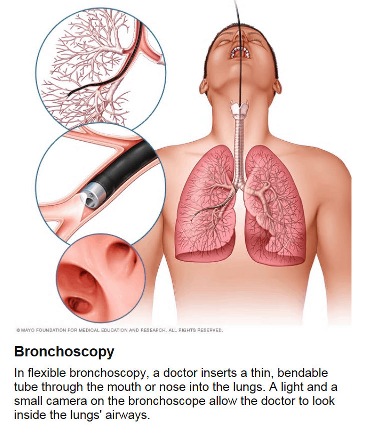 Illustration of bronchoscopy