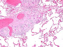 Micrograph showing pulmonary sarcoidosis with granulomas