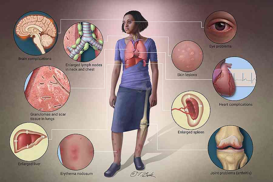 Illustration showing organs and body areas that can be affected by sarcoidosis